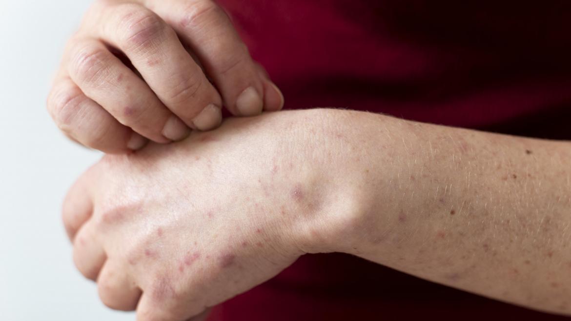Descubre la sesión internacional de Inmunodermatología organizada por el Servicio de Dermatología del Hospital público Universitario de La Princesa