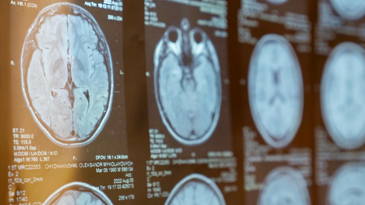 La Comunidad de Madrid aumenta en un 25% la inversión en un centro especializado para personas con esclerosis múltiple: ¡Descubre los avances en el tratamiento y atención!
