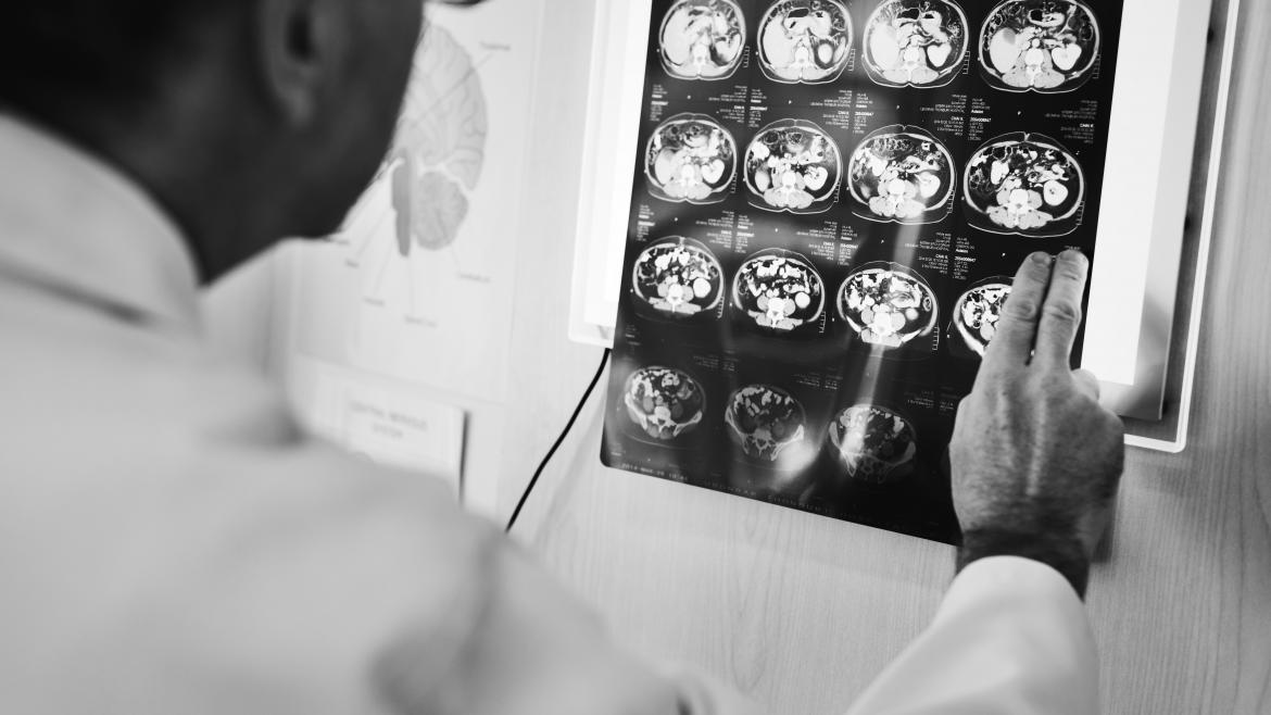 Descubre cómo el Hospital público de La Princesa ayuda a más de 500 pacientes con epilepsia cada año